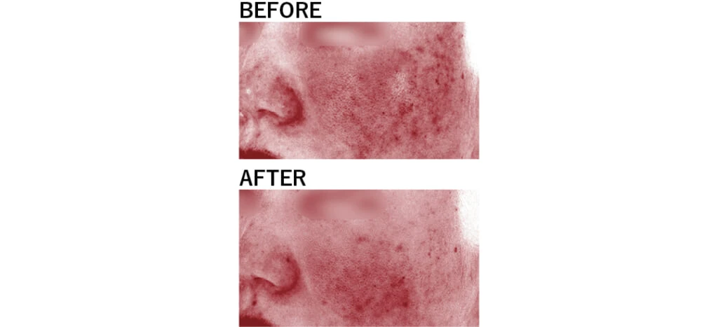 ニキビ治療Before/After